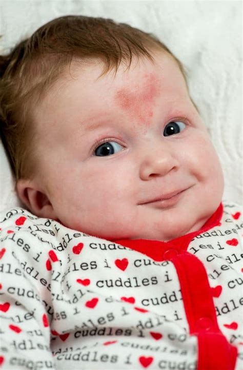 What is the rarest birthmark in the world?