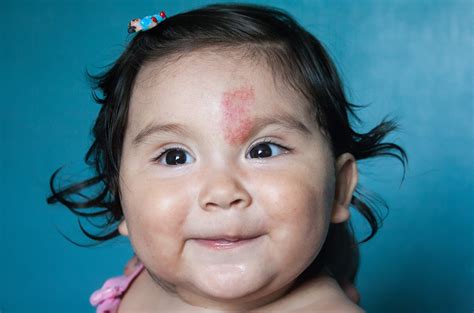 What is the rarest color of birthmarks?