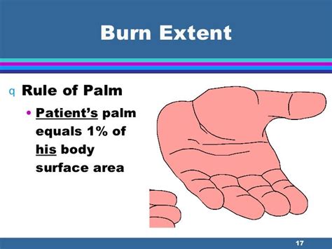 What is the rule of palm in burns?