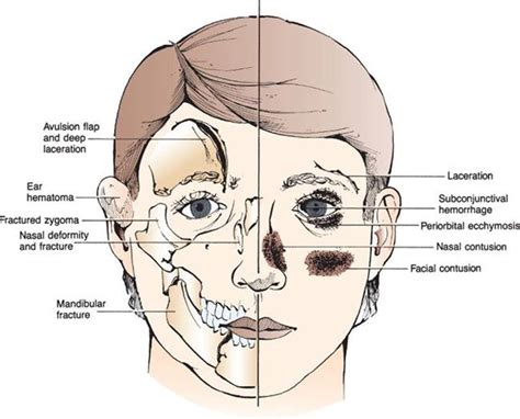 What is the stare after trauma?