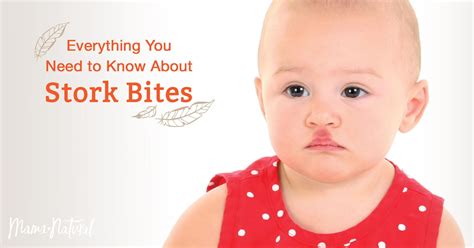 What is the stork bite baby myth?