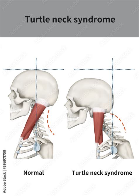 What is the turtle neck syndrome?