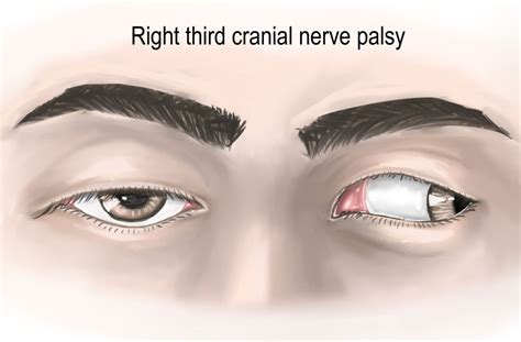 What is third nerve palsy?