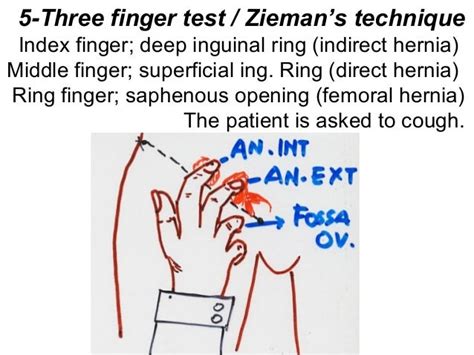 What is three finger test for hernia?