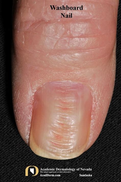 What is trauma nail?