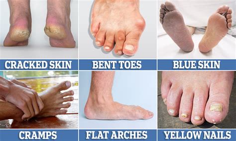 What is unhealthy feet?