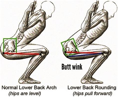 What is weak glute syndrome?