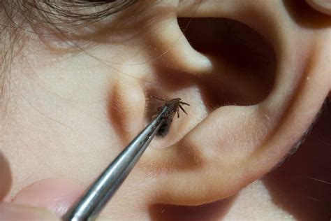 What kills bugs in ears?