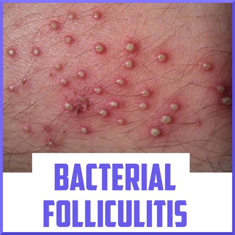 What kills folliculitis bacterial?