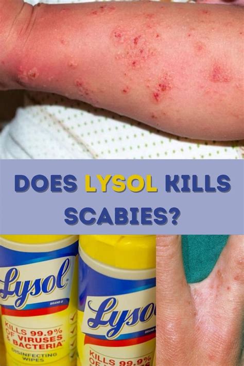 What kills scabies instantly?