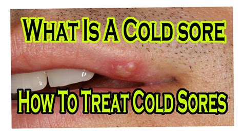 What kills the cold sore virus?