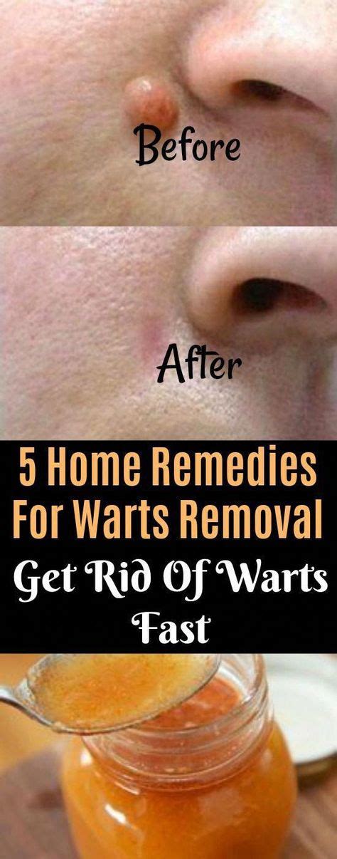 What kills warts naturally?