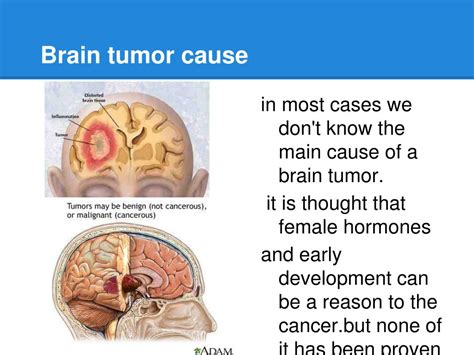 What kind of brain tumor causes phantosmia?