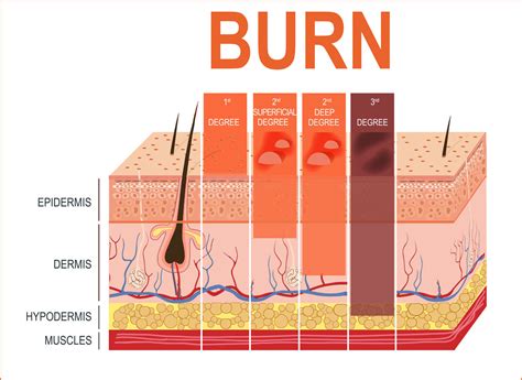 What layers of skin does a 2nd degree burn affect?