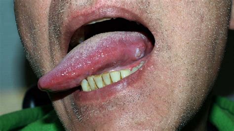 What looks like oral cancer but is not?