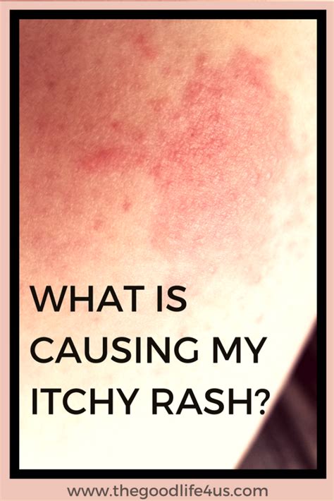 What makes a rash worse?