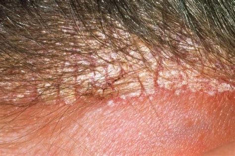 What makes seborrheic dermatitis worse?