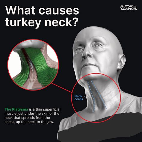 What makes turkey neck worse?