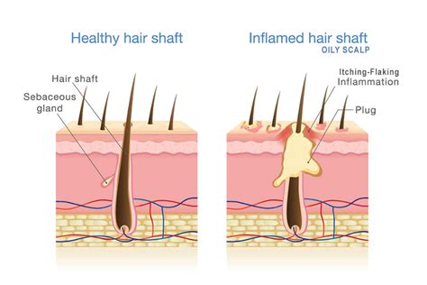 What medications cause oily hair?