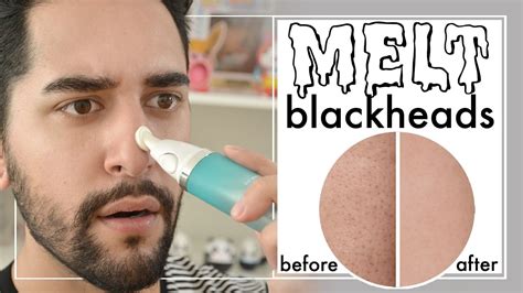 What melts away blackheads?