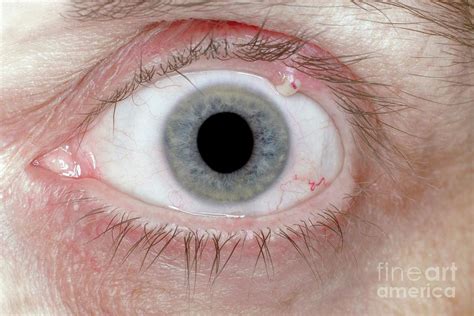 What natural bacteria is in eyes?