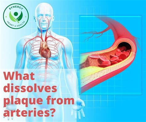 What naturally dissolves artery plaque?