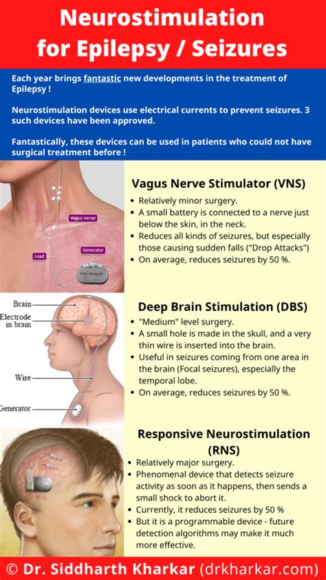 What nerve stimulation is used for focal seizures?