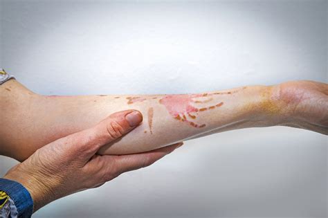 What not to do to a burn wound?
