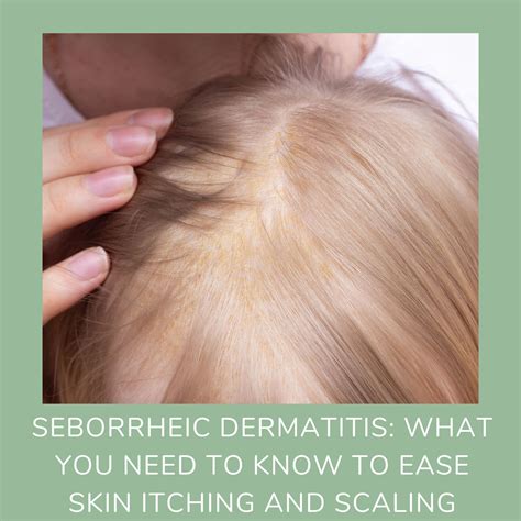 What not to do when you have seborrheic dermatitis?