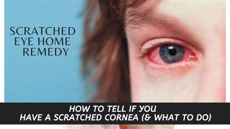 What not to do with a scratched eye?