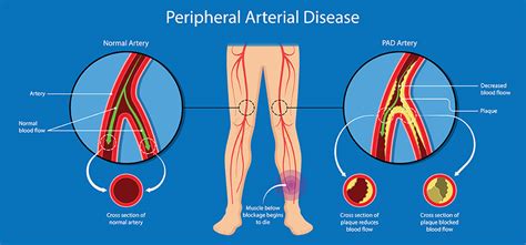 What not to do with peripheral artery disease?
