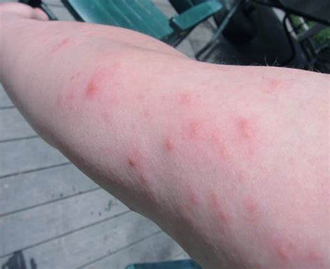 What not to do with poison ivy rash?