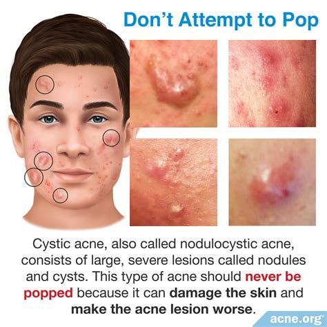 What not to use on cystic acne?