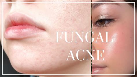 What not to use on fungal acne?