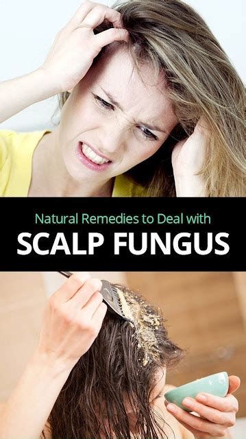 What oil kills fungus on scalp?