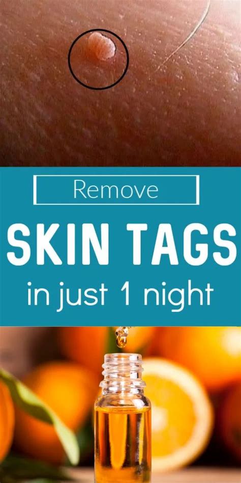 What oil kills skin tags?