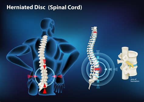 What percentage of herniated discs require surgery?
