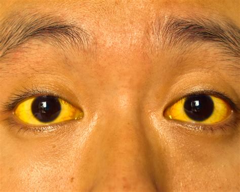 What population has yellow eyes?