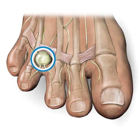 What problems can Morton's toe cause?