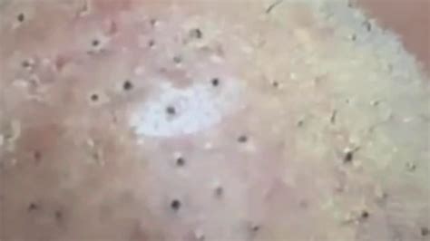 What pushes out blackheads?