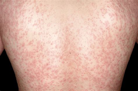 What rash lasts for months?