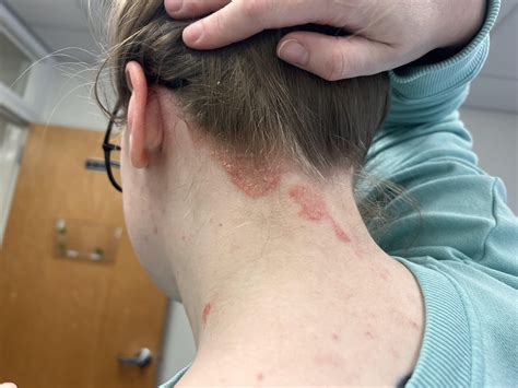 What rash progressively gets worse?