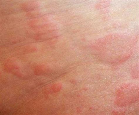 What rash spreads by scratching?