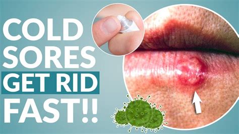 What removes cold sores fast?