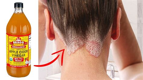 What removes fungus from hair?