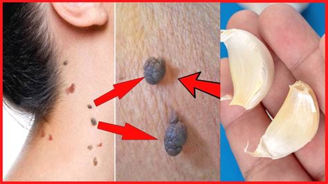 What removes skin tags instantly?