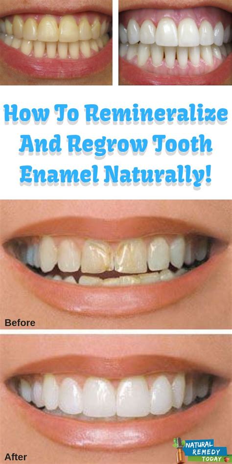 What restores enamel?
