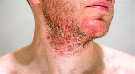 What should I avoid with seborrheic dermatitis on my face?