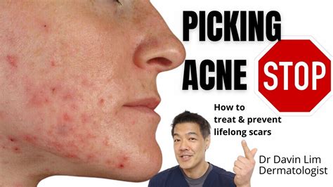 What should I put on my face after picking acne?