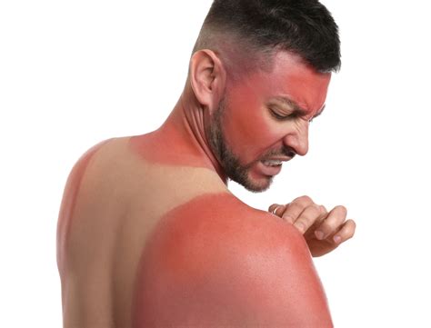 What should I wear at night for sunburn?